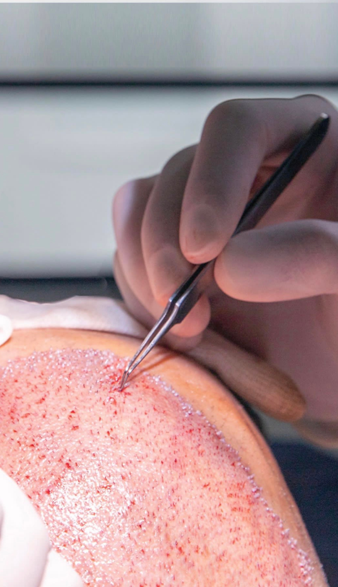 tdf-ile-sac-ekimi-ayc-health